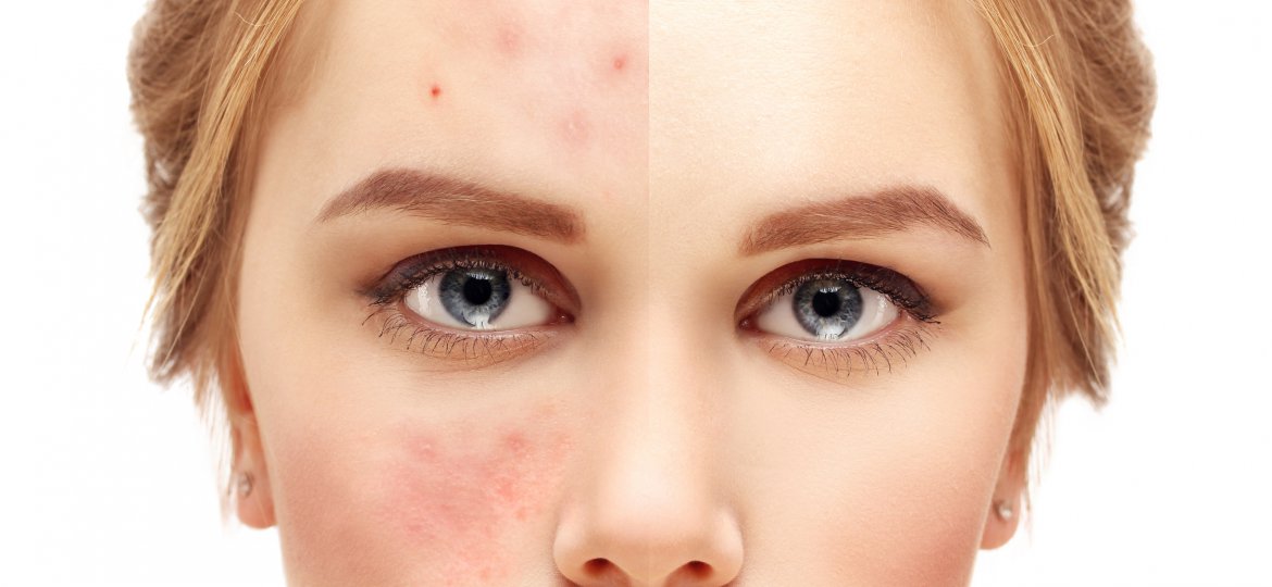 Girl with problem and clear skin.